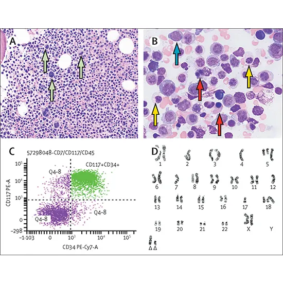 aml characterization and karyotyping combo